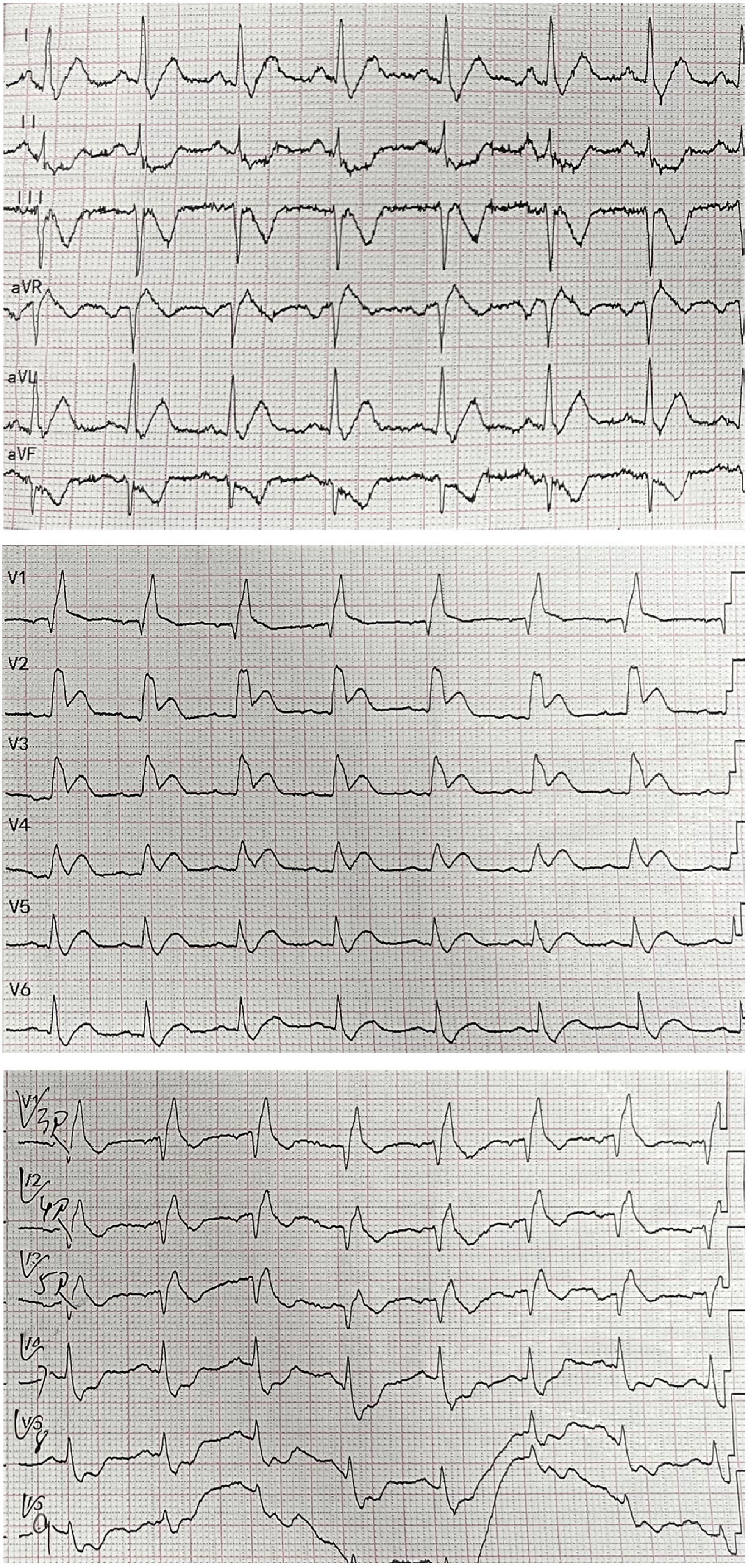 Case report: Treatment of a patient with STEMI and cardiogenic shock caused by RCA originating from LAD